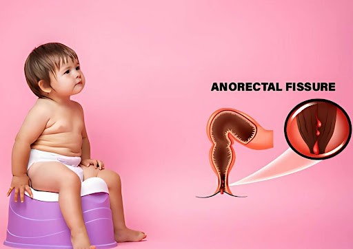 Anal Fissure